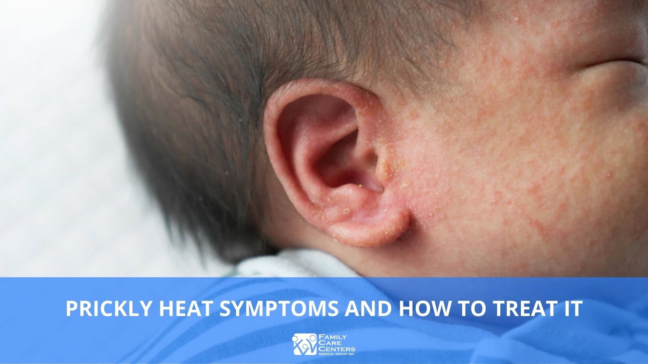 Prickly Heat Symptoms and How to Treat It