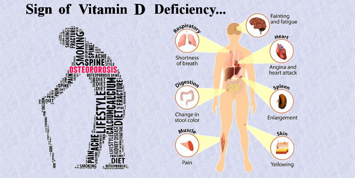 Can Low Levels of Vitamin D Cause Serious Health Concerns?