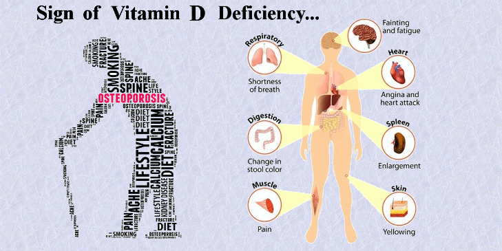 Vitamin D Deficiency Symptoms Causes CK Birla Hospital 40 OFF