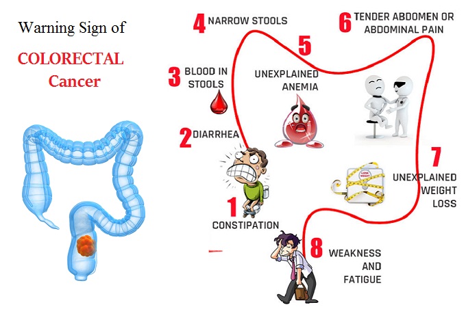 4 Important Ways to Lower Your Risk of Colorectal Cancer