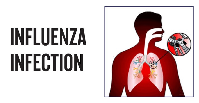 Influenza Infection