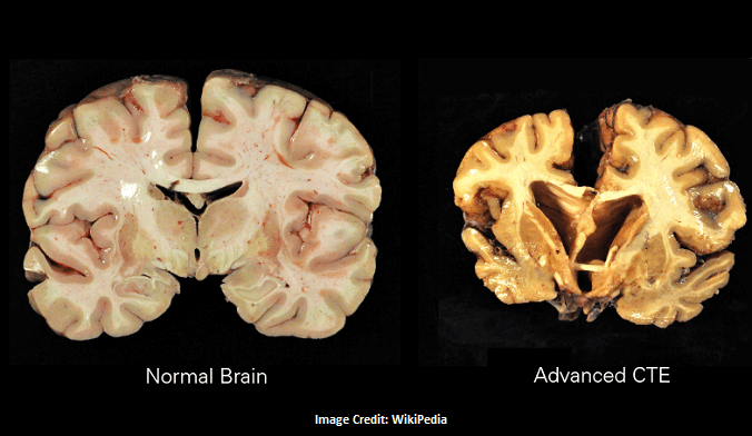 CTE Brain Disease: Its Symptoms, Causes & Treatment