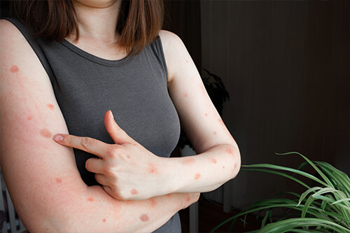 Get Monkey Pox Testing & Treatment Recommendations!