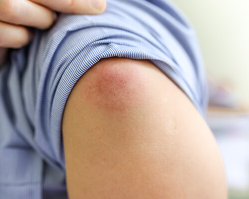 Cellulitis in Orange County