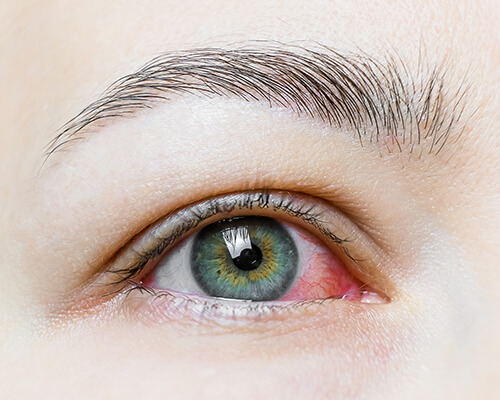 Pink eye
